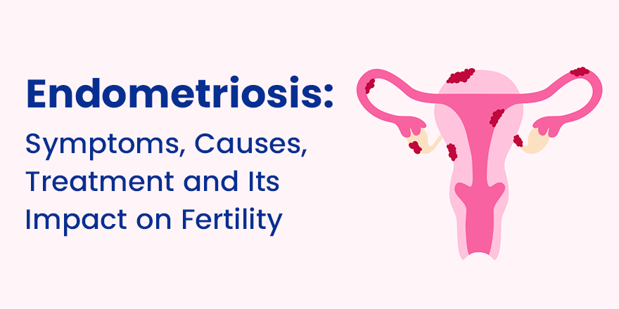 Endometriosis: Symptoms, Causes, Treatment and Its Impact on Fertility