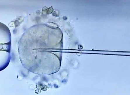 ICSI of the Mature Oocyte