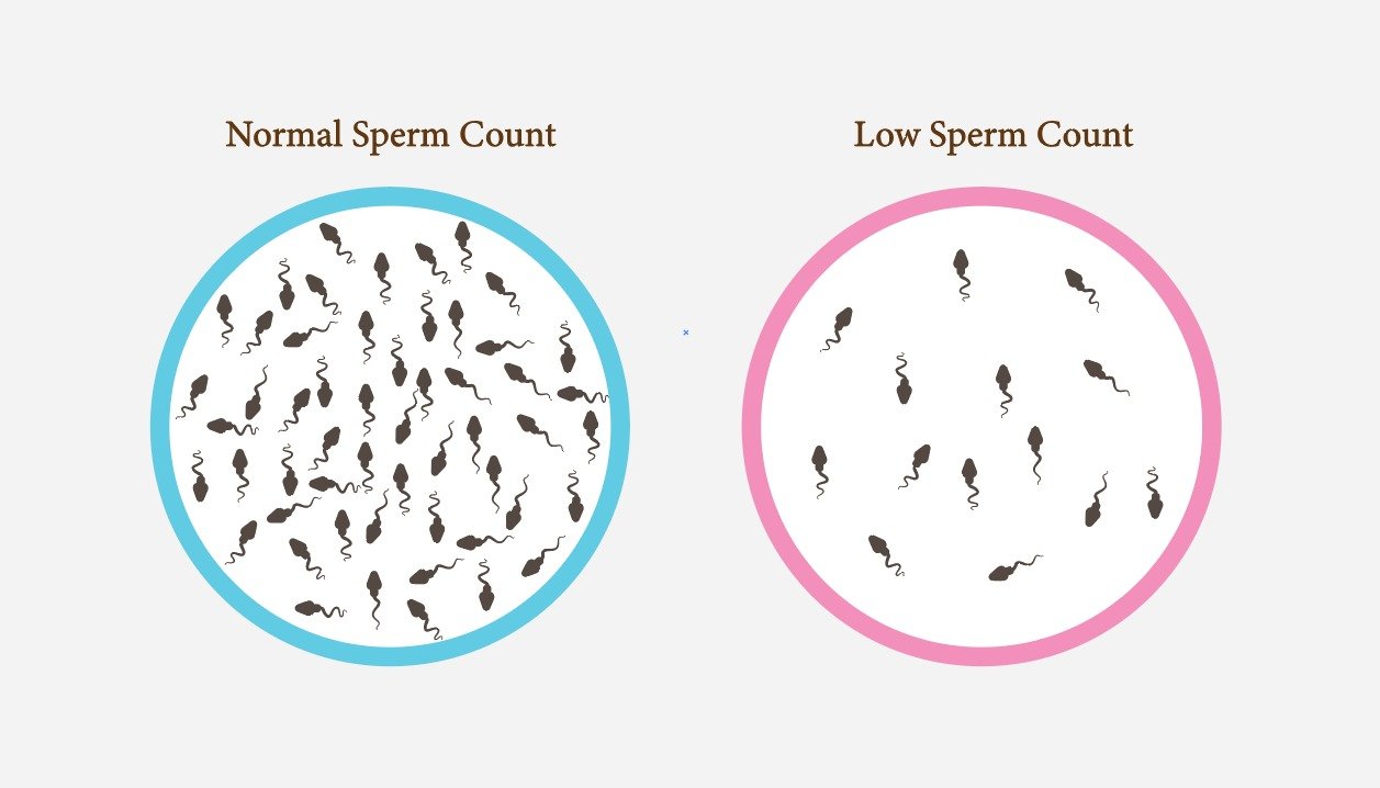 Azoospermia